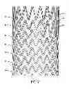 Fig. 08 - SELF-EXPANDING STENT