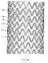 Fig. 14 - SELF-EXPANDING STENT