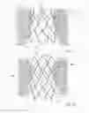 Fig. 03 - Sizing device and method of positioning a prosthetic heart valve