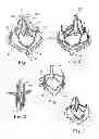Fig. 02 - Delivery systems and methods of implantation for replacement prosthetic heart valve