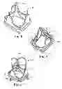 Fig. 03 - Delivery systems and methods of implantation for replacement prosthetic heart valve