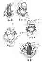 Fig. 04 - Delivery systems and methods of implantation for replacement prosthetic heart valve