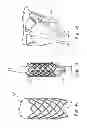 Fig. 15 - Delivery systems and methods of implantation for replacement prosthetic heart valve