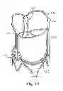 Fig. 16 - Delivery systems and methods of implantation for replacement prosthetic heart valve