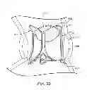 Fig. 17 - Delivery systems and methods of implantation for replacement prosthetic heart valve