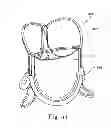 Fig. 18 - Delivery systems and methods of implantation for replacement prosthetic heart valve