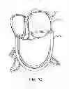 Fig. 19 - Delivery systems and methods of implantation for replacement prosthetic heart valve
