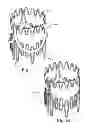 Fig. 22 - Delivery systems and methods of implantation for replacement prosthetic heart valve