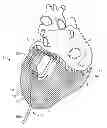 Fig. 01 - Cardiac treatment system