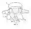 Fig. 06 - Facet Joint Replacement