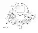 Fig. 08 - Facet Joint Replacement