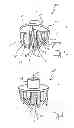 Fig. 02 - Shoulder prosthesis