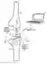 Fig. 01 - Hermetically sealed prosthetic component and method therefor