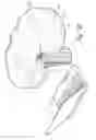 Fig. 23 - Hermetically sealed prosthetic component and method therefor