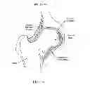 Fig. 07 - Method and apparatus for accessing the interior of a hip joint, including the provision and use of a novel telescoping access cannula and a novel telescoping obturator