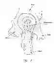 Fig. 08 - Method and apparatus for accessing the interior of a hip joint, including the provision and use of a novel telescoping access cannula and a novel telescoping obturator