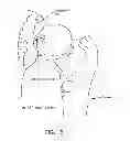 Fig. 09 - Method and apparatus for accessing the interior of a hip joint, including the provision and use of a novel telescoping access cannula and a novel telescoping obturator