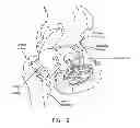 Fig. 10 - Method and apparatus for accessing the interior of a hip joint, including the provision and use of a novel telescoping access cannula and a novel telescoping obturator