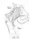 Fig. 12 - Method and apparatus for accessing the interior of a hip joint, including the provision and use of a novel telescoping access cannula and a novel telescoping obturator