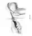 Fig. 29 - Method and apparatus for accessing the interior of a hip joint, including the provision and use of a novel telescoping access cannula and a novel telescoping obturator