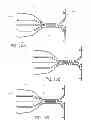 Fig. 11 - Articulable anchor