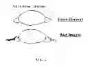 Fig. 06 - Systems and methods for customizing adjustable intraocular lenses