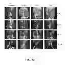 Fig. 22 - Melanocortin 1 receptor ligands and methods of use