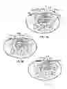 Fig. 05 - Therapeutic skin lifting device and related systems and methods