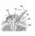 Fig. 01 - Materials and methods for repair of cartilage defects