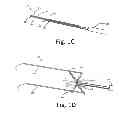 Fig. 04 - X-shaped device and method for deployment and placement of a patch