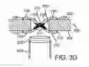 Fig. 01 - Flow obstructor and transapical closure device