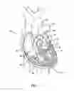Fig. 02 - Transapical mitral valve repair device