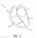 Fig. 04 - Transapical mitral valve repair device