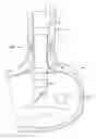 Fig. 01 - Anti-reflux prosthesis