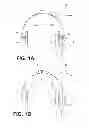 Fig. 02 - HEARING DEVICE WITH A DISTANCE MEASUREMENT UNIT