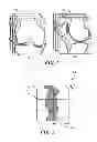 Fig. 02 - Fusion of multiple imaging planes for isotropic imaging in MRI and quantitative image analysis using isotropic or near-isotropic imaging
