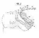 Fig. 04 - Expandable Inter Vivos Tube