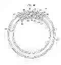 Fig. 06 - Expandable Inter Vivos Tube