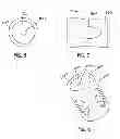 Fig. 04 - NAIL POLISH PROTECTOR SLEEVE