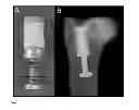 Fig. 09 - CALCIUM SULPHATE BASED COMPOSITE