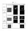 Fig. 06 - Method of sequential and multiple immunostaining for detection of various antigens in the same specimens