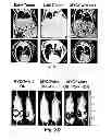 Fig. 06 - METHOD OF DETERMINING THE PROGNOSIS OF HEPATOCELLULAR CARCINOMAS USING A MULTIGENE SIGNATURE ASSOCIATED WITH METASTASIS