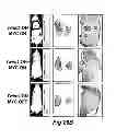 Fig. 29 - METHOD OF DETERMINING THE PROGNOSIS OF HEPATOCELLULAR CARCINOMAS USING A MULTIGENE SIGNATURE ASSOCIATED WITH METASTASIS