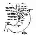 Fig. 02 - TRANSESOPHAGEAL GASTRIC REDUCTION METHOD AND DEVICE FOR PRACTICING SAME