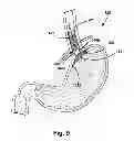 Fig. 09 - Intraluminal device and method with enhanced anti-migration