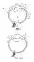 Fig. 02 - Implantable therapeutic device