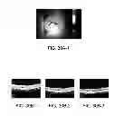 Fig. 68 - Implantable therapeutic device