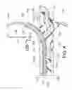 Fig. 05 - Transvascular catheter for extravascular delivery