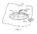 Fig. 02 - WOUND DRESSING ASSEMBLY WITH ABSORBENT LAYER