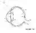 Fig. 02 - SURGICAL LASER SETUP CALCULATIONS INTERFACE FOR CORNEAL MULTI-PLANE INCISION